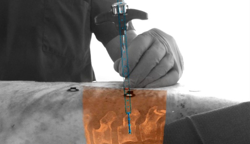 Philips-AR-Spinal-Surgery