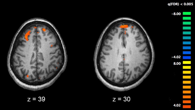 脳のfMRI画像